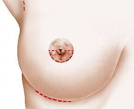 Augmentation mammaire