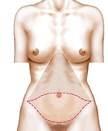 Abdominoplastie Abdominoplastie