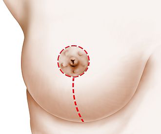 Chirurgie de la ptose