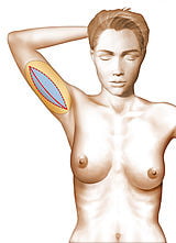 Lifting de bras Lifting de bras