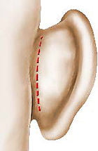 Chirurgie des oreilles décollées Chirurgie des oreilles décollées