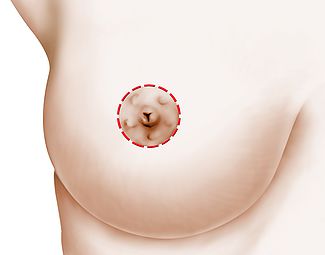 Chirurgie de la ptose