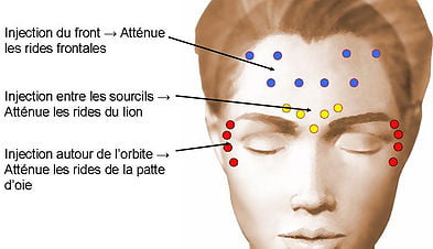 Injections de Toxine Botulique